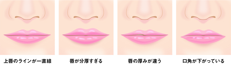 M字リップ形成